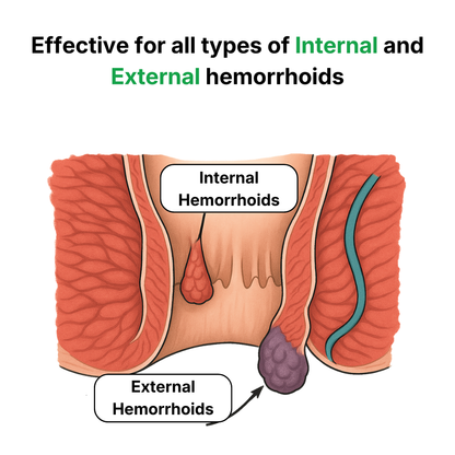 EasyHemo Rescue™ — Complete 21-Day Recovery System (3 Tubes)